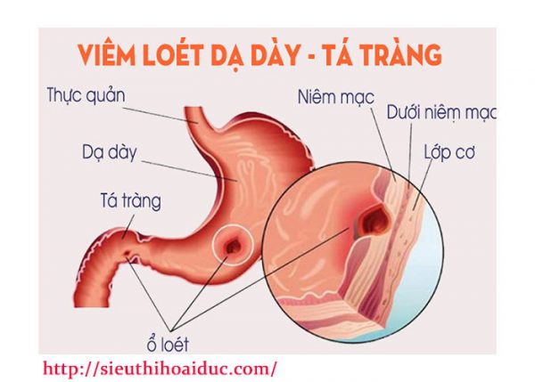 Viêm Loét Dạ Dày